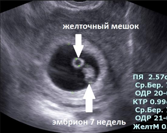 Can they not see pregnancy on an ultrasound? What do they look for on an ultrasound?