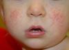 Penyebab diatesis pada anak-anak: foto, metode pengobatan dan pencegahan