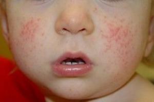 Causes of diathesis in children: photos, methods of treatment and prevention