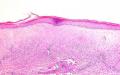 Trattamento del lichen sclerosus genitale negli uomini - raccomandazioni della British Association of Dermatologists (traduzione e adattamento del Prof.