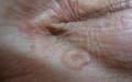 Диагностика и лечение на базалноклетъчен карцином на кожата