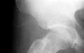 Остеопороз кісток – види, причини, лікування Зруйнування кісток хвороба назва у дорослих