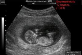 Pemeriksaan dan skrining pada minggu ke-12 kehamilan Skrining pertama 12 minggu normal