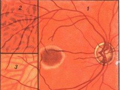 Конгестивен диск на зрителния нерв: причини, симптоми и особености на лечението на границите на зрителния нерв не са ясни, вените са разширени