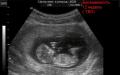 Обстеження та скринінг на дванадцятому тижні вагітності Перший скринінг 12 тижнів норми
