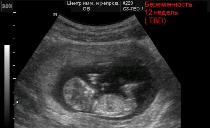 Обстеження та скринінг на дванадцятому тижні вагітності Перший скринінг 12 тижнів норми