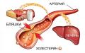 Symptoms and treatment of atherosclerosis