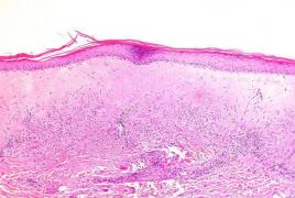 Liečba genitálneho lichen sclerosus u mužov - odporúčania Britskej asociácie dermatológov (preklad a úprava prof.