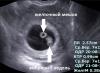 Ultrasonda hamileliği göremezler mi Ultrasonda ne bakarlar