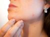 After childbirth, acne and a rash on the face: causes of acne on the chin and treatment Why, after childbirth, the whole face is covered in acne