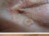 Диагностика и лечение на базалноклетъчен карцином на кожата