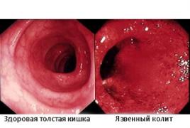 Nešpecifická ulcerózna kolitída (UC): čo to je, príčiny, symptómy, diagnostika a liečba