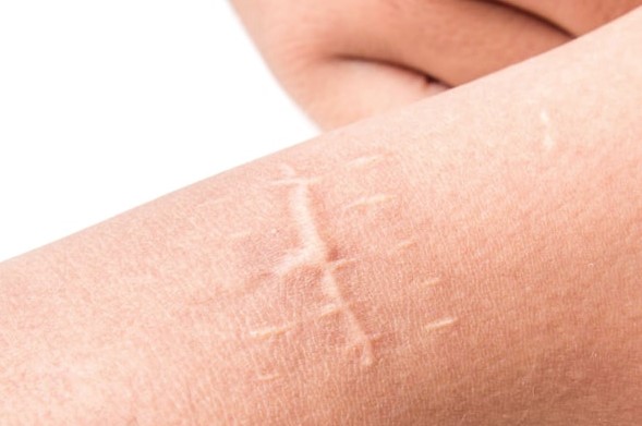 Лечение рубцов: удаление рубцов после операций